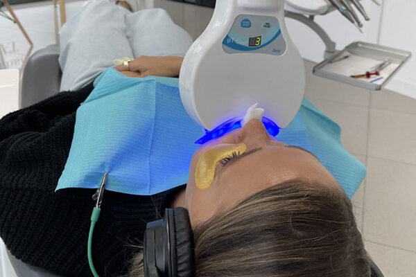 blanqueamiento dental clinica mg dental