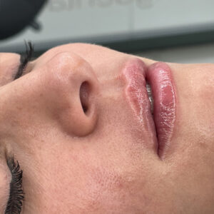 ácido hialuronico clínica mg dental