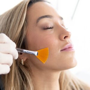 peeling-quimico-facial-clinica-mg-dental