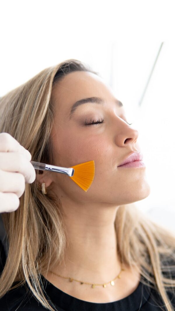 peeling-quimico-facial-clinica-mg-dental